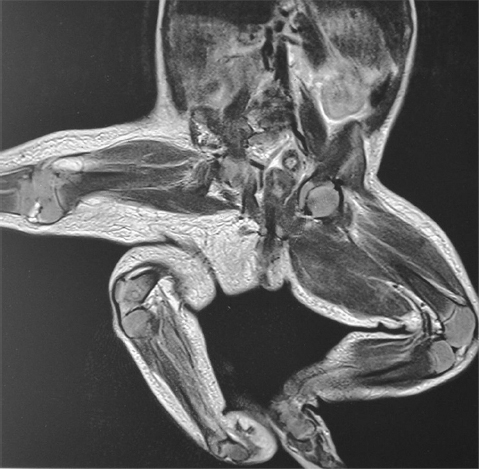 Magnetic resonance imaging pelvis showing the parasitic limb with the hip joint and femur.